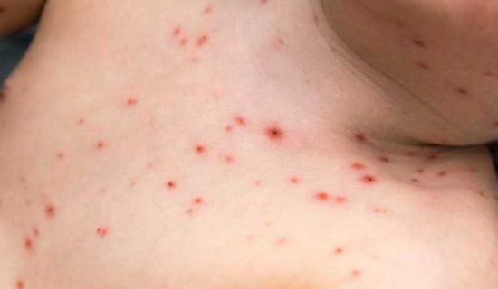 استنفار بالمدارس لاتخاذ تدابير وقائية بسبب داء الحصبة ( بوحمرون) 